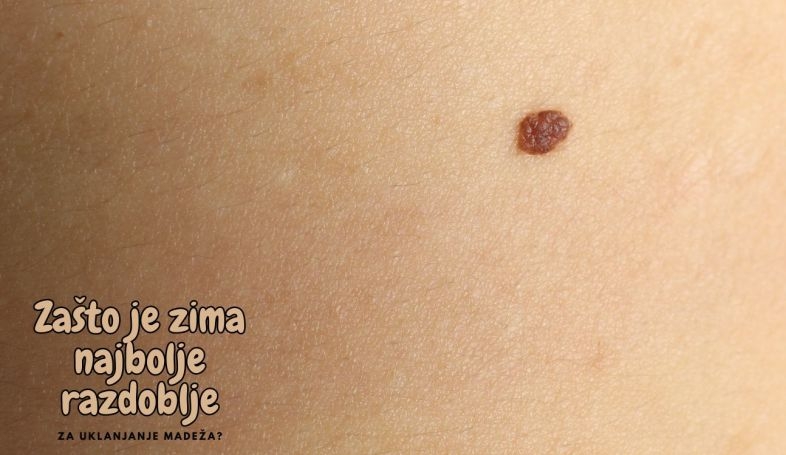 Zašto je zima najbolje razdoblje za uklanjanje madeža?